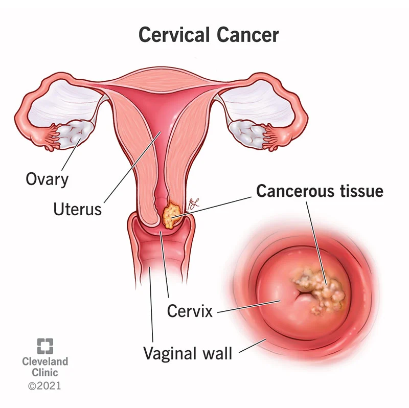 HPV genotyping & Pap Smear